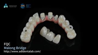 مالو بريدج لحلول طب الأسنان من ADL