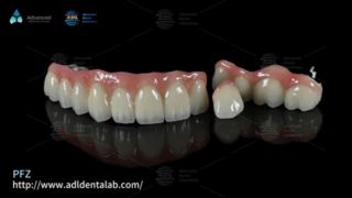 تيجان الأسنان PFZ ذات قوة طبيعية وملاءمة دقيقة