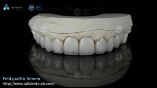 قشور سيراميك فيلدسباثيك عالية الشفافية للابتسامات