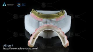 ترميمات أسنان متميزة، إنجاز سريع