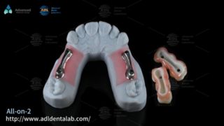 شريط زراعة التيتانيوم الفاخر لطب الأسنان All On X