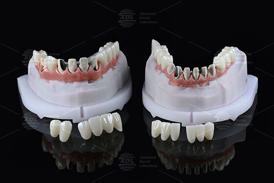 شراء جسر هجين من التيتانيوم بالكامل لقوس الأسنان من مختبر أسنان صيني مع تحميل فوري بظل A1 تصميم مالون مثبت بالبراغي بتقنية CAD/CAM التصنيع عبر الإنترنت