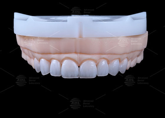 China Dental Lab Over 13 Years In Dental Lab Industry Providing Emax Veneer 16 Shades To Meet Diverse Dental Restoration Needs